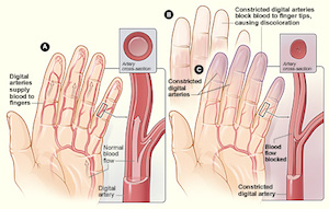 Raynaud-Graphik-DocCheck_page_1