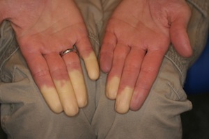 morbus-raynaud_page_1